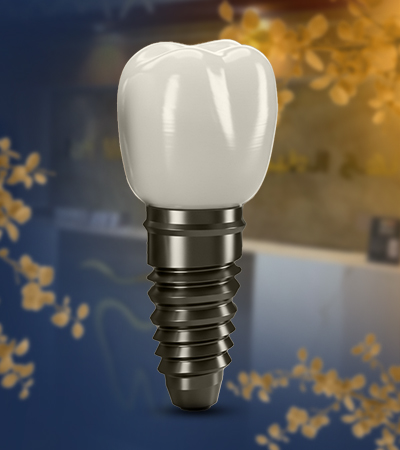 زراعة الأسنان